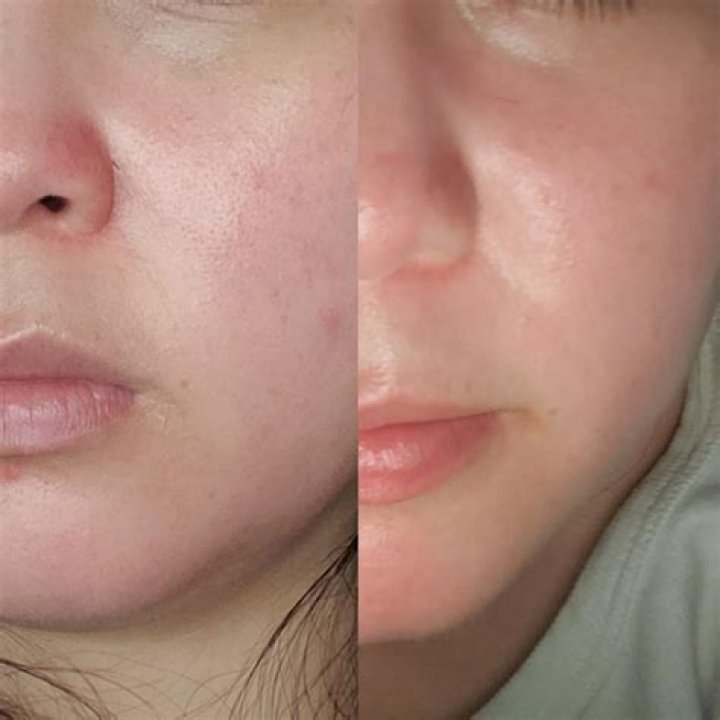 Adapalene Before and After: Transforming Your Skin with This Powerful Ingredient
