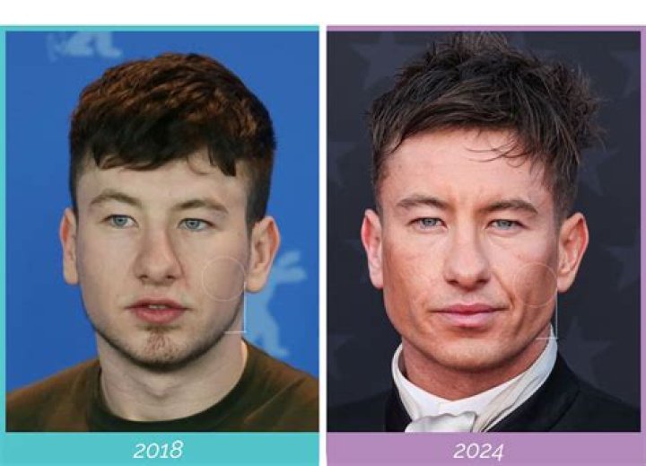 Unraveling the Mystery of Barry Keoghan Surgery
