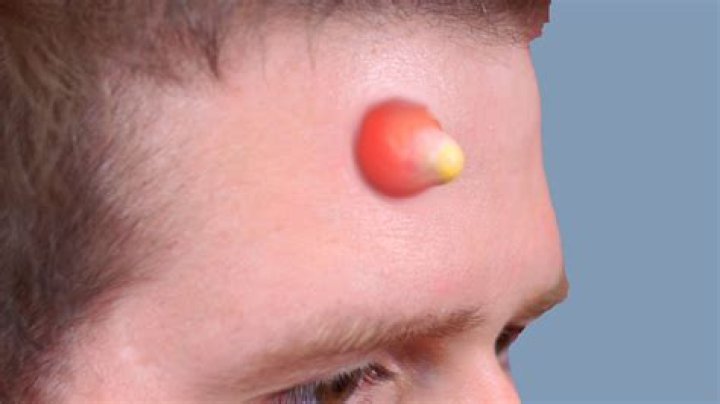 The Biggest Pimple in the World: A Comprehensive Exploration