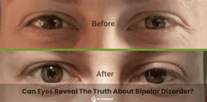 Bipolar Eyes Before and After: Transforming Your Gaze