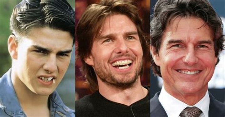 Celebrities That Wear Dentures: A Closer Look at Their Smiles