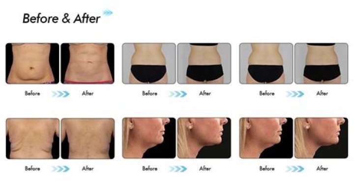 Cryo Slimming Before and After: A Comprehensive Guide to Fat Freezing Treatments