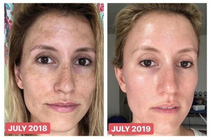 Differin Adapalene Before and After: Transforming Skin with Proven Results