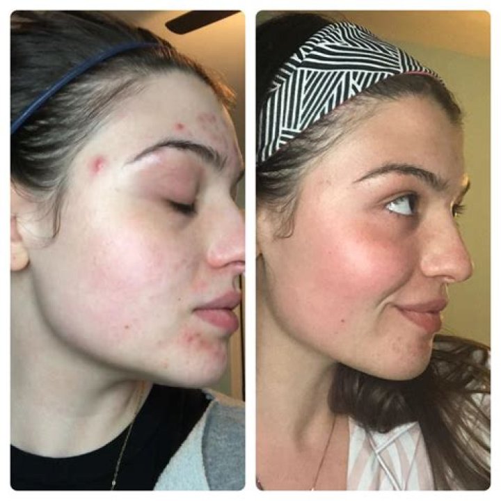 Differin Before and After: Transformative Results for Clearer Skin