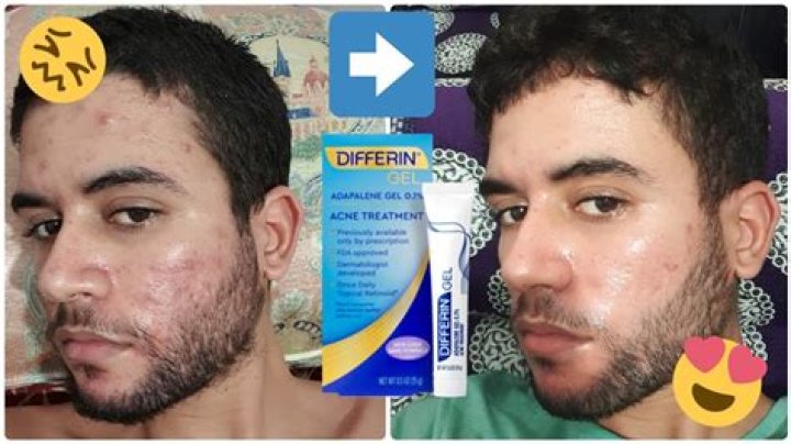 Differin Gel Before and After: Transforming Your Skin for the Better
