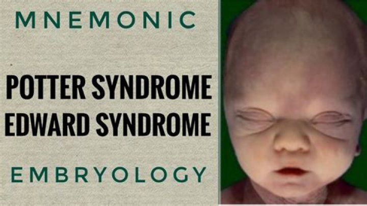 Understanding Edward Bluemel Syndrome: Causes, Symptoms, and Management