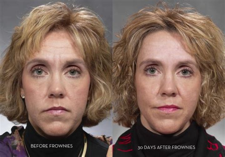 Frownies Before and After: Transform Your Look Naturally