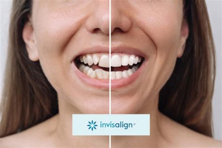 How Long Was B. Simone and Invisalign Together? A Comprehensive Look