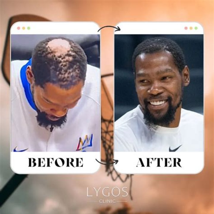 Kevin Durant Hair: A Deep Dive into His Iconic Hairstyle