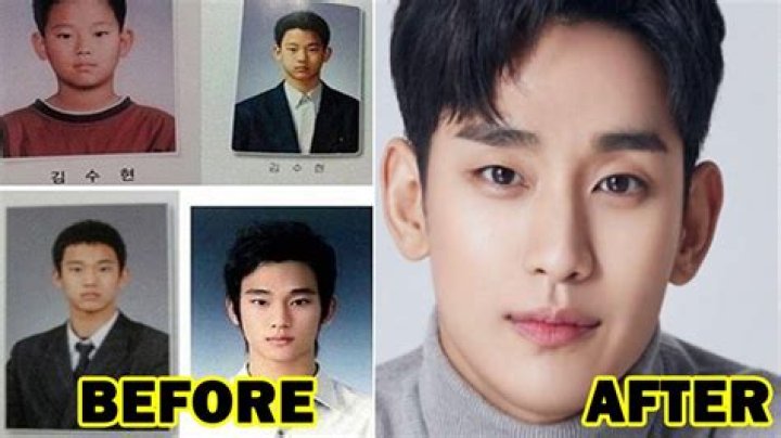 Kim Soo Hyun Plastic Surgery: Unveiling the Truth Behind the Transformation