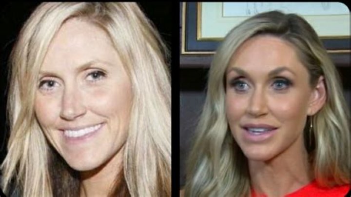 Lara Trump Plastic Surgery: A Comprehensive Look at Her Transformation