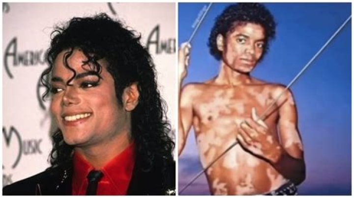 Michael Jackson Skin Condition: Unveiling the Truth Behind His Iconic Transformation