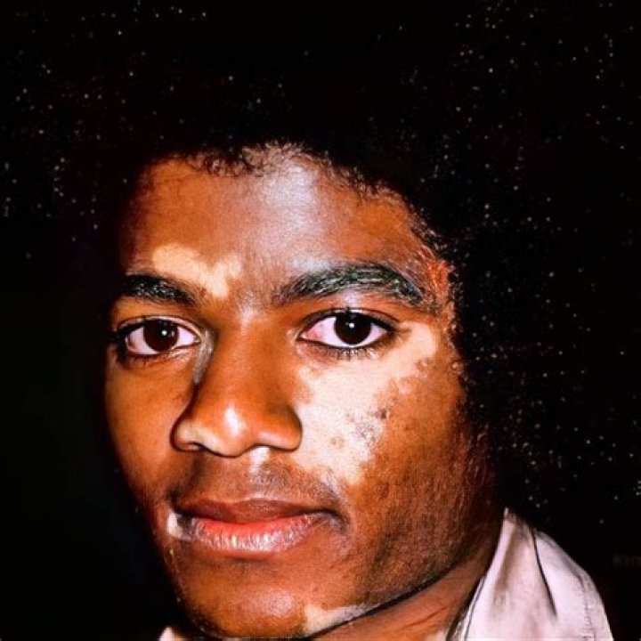 Michael Jackson Skin Disorder: Unveiling the Truth Behind the Icon's Transformation