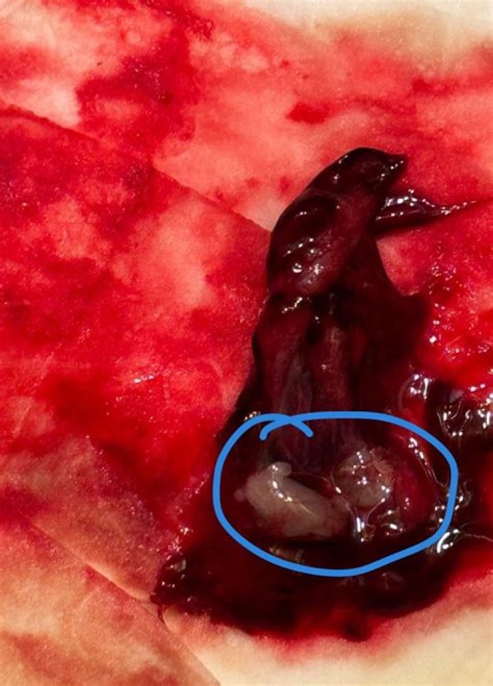 Understanding Miscarriage Photos at 6 Weeks: A Comprehensive Guide