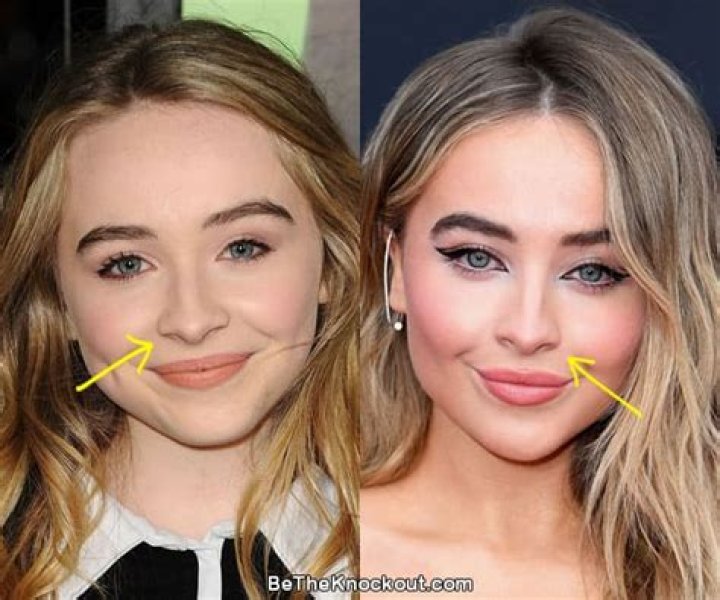 Sabrina Carpenter Nose Job: The Truth Behind Her Transformation