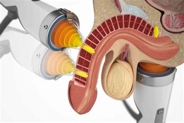 Salt Therapy for Erectile Dysfunction: A Comprehensive Guide to Its Benefits and Effectiveness