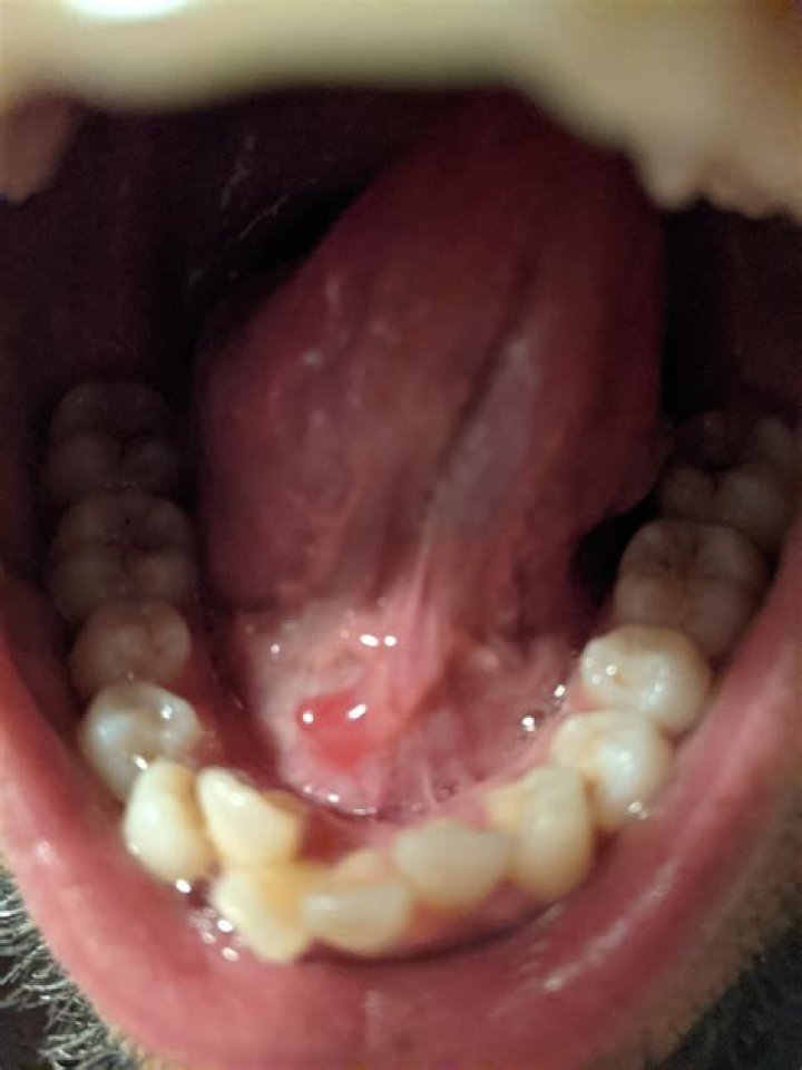 Salt Under Tongue for ED: A Comprehensive Guide