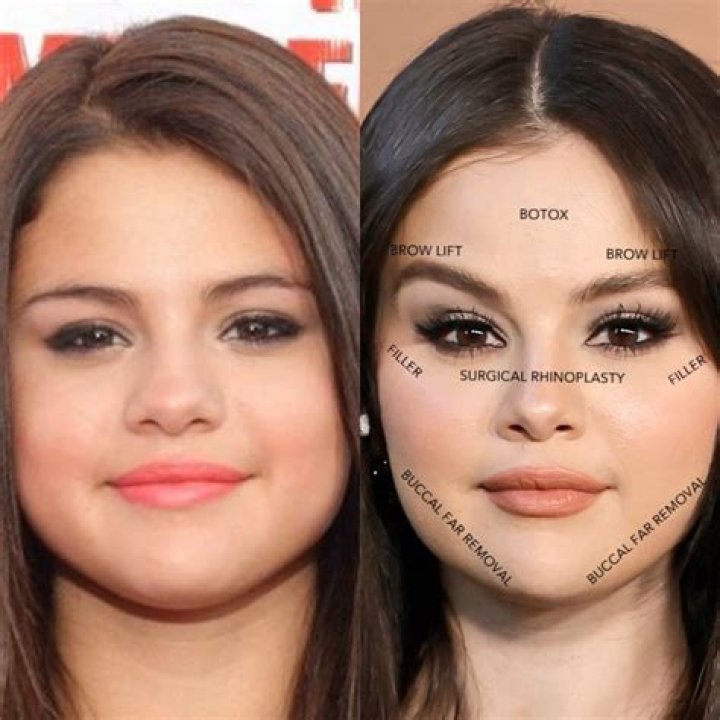 Unveiling the Truth: Selena Gomez Plastic Surgery Rumors and Reality