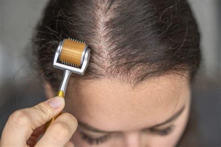 Which Derma Roller Size is Best for Hair Regrowth?