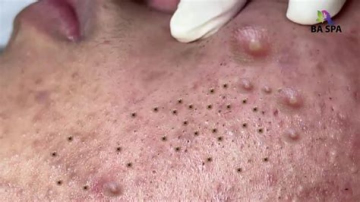 The Fascinating World of Zit Popping: Understanding the Science and Art Behind It